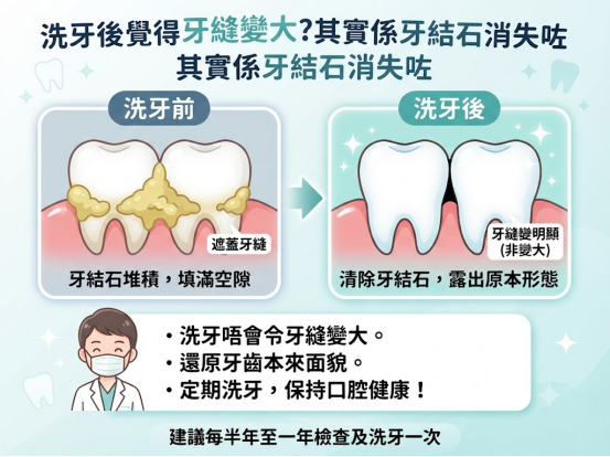 洗牙會令牙縫變大嗎？很多人誤會了，牙醫揭開真正原因